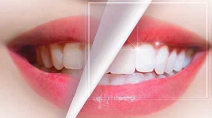 Bandes de blanchiment des dents avant et après