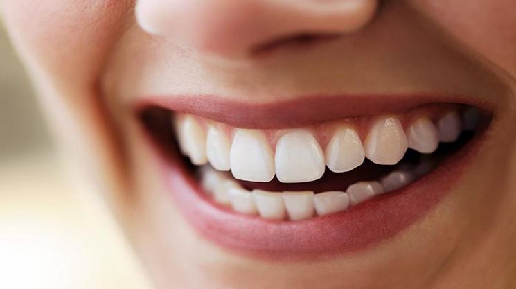 Blanchiment des dents sans peroxyde : est-ce efficace et est-ce sûr ?